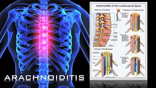 Epidural Steroid Injections amp Arachnoiditis  FDAPROP HEARING [upl. by Akerdna675]