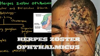 Herpes Zoster Ophthalmicus  Very Important [upl. by Nicks]