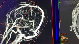 Angiografia venosa 2DTOF es diagnostica [upl. by Arodnap938]