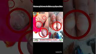 wart treatment in tamil  warts removal in tamil  maru poga tips in tamil  dr balajimuthu [upl. by Limemann]