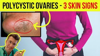 Doctor explains 3 SKIN SIGNS ASSOCIATED WITH POLYCYSTIC OVARIAN SYNDROME PCOS [upl. by Patsis838]