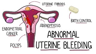 Abnormal Uterine Bleeding AUB  Menorrhagia amp Heavy Menstrual Bleeding  Including Mnemonic [upl. by Iruj]