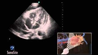 How To Ultrasound Guided Pericardiocentesis Procedure 3D Video [upl. by Jillian]