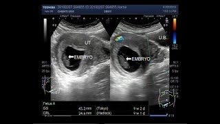 Ultrasound Video showing a case of Missed abortion [upl. by Atcliffe213]