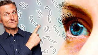 What Causes Eye Floaters and Dry Eyes [upl. by Chas799]