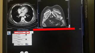 ANGIOTOMOGRAFIA DE AORTA TORÁCICA  DIEGO CESAR [upl. by Iruy]