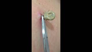 Tick removal by US doctor [upl. by Adirehs]