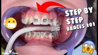 Dental Braces  Step by Step  Tooth Time Family Dentistry New Braunfels [upl. by Anairb]