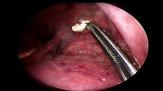 Removing LARGE Tonsil Stone  Doctor Anh [upl. by Lleze552]