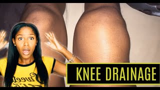 Story Time RAW FOOTAGE My Knee Aspiration PICTURES  Knee Drainage  Rheumatoid Arthritis [upl. by Yttocs]