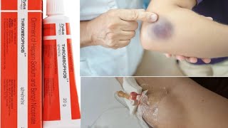 Thrombophob ointment  Treatment ofThrombosis  Superficial Blood Clotting  medicine information [upl. by Hersh]