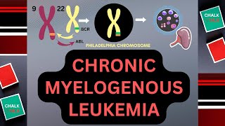 CHRONIC MYELOGENOUS LEUKEMIA CML [upl. by Janiuszck]