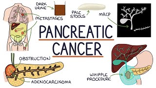 Understanding Pancreatic Cancer [upl. by Erdreid]