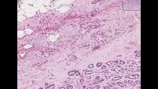 Histopathology Prostate Adenocarcinoma Gleason grade 3 [upl. by Codd]