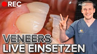 Veneers einsetzen LIVE  Wir zeigen die ganze Transformation im Oberkiefer [upl. by Ahsei]