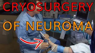 Cryosurgery of Neuroma  Dr M Horwitz  Feet For Life St Louis amp Chesterfield Missouri [upl. by Yoong817]