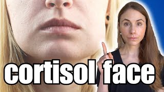 Do You Suffer From Cortisol Face [upl. by Ahsiym]