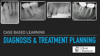 Case Based Learning Diagnosis and Treatment Planning in Endodontics [upl. by Debbra]