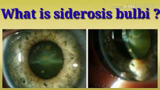 What is Siderosis bulbi  intraocular foreign body [upl. by Lienet]