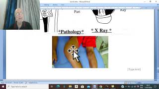 Orthopaedic in Arabic 63  Osteogenic sarcoma  clinical pictures amp treatment   by DrWahdan [upl. by Moor971]