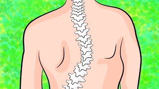 How to get rid of upper back scoliosis in 4 minutes a day [upl. by Kally]