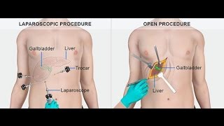 What are Gallstones Causes Symptoms  Treatment of Gallstone [upl. by Acinoryt717]