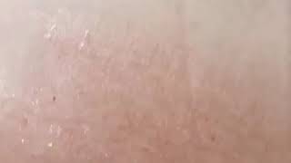 Microneedling for Stretchmarks [upl. by Kenay]