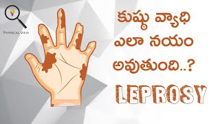 LEPROSY  కుష్ఠు వ్యాధి  LEPROSY IN TELUGU [upl. by Viva]