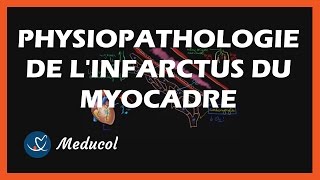 Infarctus du myocarde  symptômes et physiopathologie de la crise cardiaque [upl. by Sivel717]