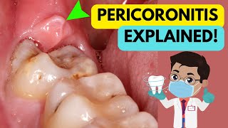 PERICORONITIS EXPLAINED IN 5 MINUTES CAUSE SYMPTOMS DIAGNOSIS AND TREATMENT [upl. by Naicad860]