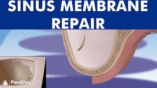 Sinus membrane perforation repair © [upl. by Nivart]