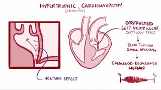 Hypertrophic cardiomyopathy HCM causes symptoms treatment amp pathology [upl. by Ellenej]