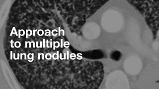 Algorithmic Approach to Multiple Lung Nodules [upl. by Meehyrb]