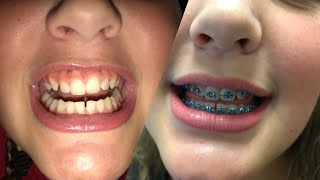 Getting Braces and Palate Expander [upl. by Ahsyek]