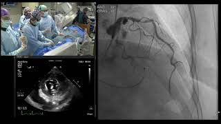 TMVR in MAC with Antegrade LAMPOON amp alcohol septal ablation [upl. by Bittencourt]