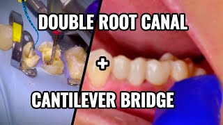 90 Double Root Canal  Cantilever Bridge [upl. by Riccardo]