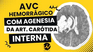 AVC Hemorrágico com Agenesia da Artéria Carótida Interna [upl. by Meingolda]