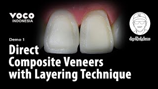 Direct Composite Veneers with Layering Technique using AMARIS  Operative Dentistry  VOCO GmbH [upl. by Riddle]