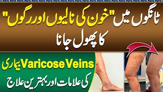 Tango Ki Ragon Ka Phool Jana Varicose Veins Causes and Treatment  Veins ka ilaj  Varicose Veins [upl. by Analahs]