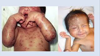 Lecture 205 Dermatoses of the Neonates Part3 Rook 10th ed Ch114 [upl. by Ches]