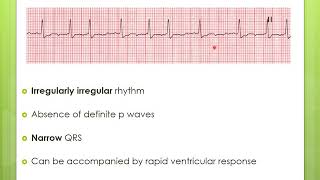 Cardiac dysrhythmia Lecture B [upl. by Aivon907]