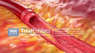 3D Medical Animation of Coronary Angioplasty with Stent Placement [upl. by Adranoel]