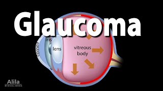 Development of Glaucoma Animation Open Angle vs Angle Closure Glaucoma [upl. by Norean70]