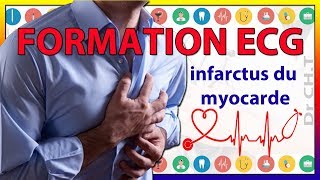 ECG de linfarctus du myocarde [upl. by Ilime]