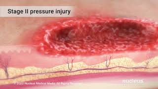 Pressure Injuries [upl. by Deva239]