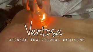 Ventosa  Cupping Therapy  Traditional Chinese Medicine  Do It Yourself [upl. by Pasho827]