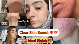 Best Treatment for Acne Dark Spots Pigmentation and Scars  Dermatologist Recommended Products [upl. by Gievlos]