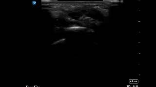 Wrist Ultrasound Arthrocentesis in Short Axis [upl. by Dustie]