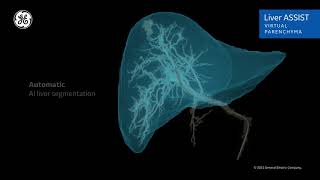 Introduction to GE Healthcare Liver ASSIST Virtual Parenchyma [upl. by Carena]