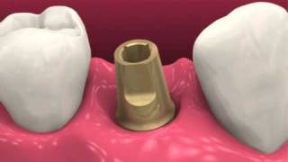 Restoring dental implants video BioHorizons [upl. by Kelsey287]